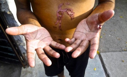 Napoleon shows his wounds from the last four days, traveling by foot from the southern border of Mexico to Chauhuites, Oaxaca. 4 days prior, the Salvadoran man, while accompanying his 17 year old son on his journey to the US, stopped to ask a local for water. The woman instead threw boiling water at him. The next day, he and his son were stripped, robbed, and assaulted. They managed to escape with their lives, but the memory and machete to Napoleon's hand still serve as reminders. August 3rd, 2015 photo by Janice Amaya